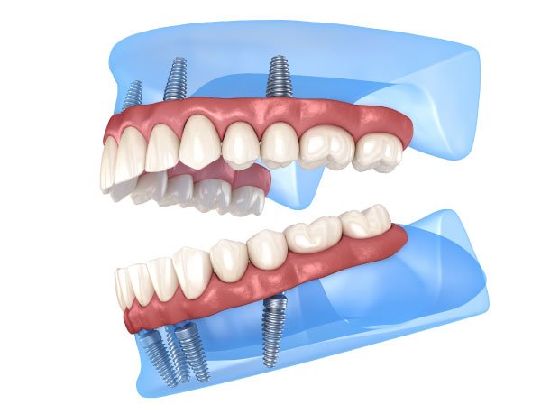 Full Arch Dental Implants in Seattle, WA