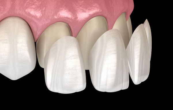 Seattle Porcelain Veneer Dentist